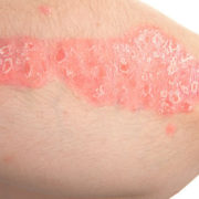 Psoriasis-689892